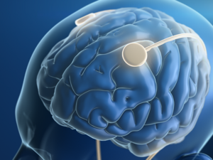 Schrittmacher im menschlichen Gehirn