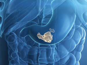 Magenkrebs - Bösartiger Tumor im Magen