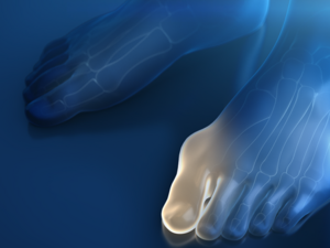 Hallux valgus: Fehlstellung des Großzehs