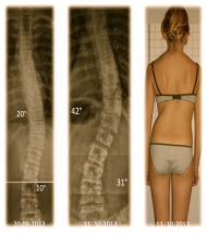 Bild Skoliose mit Krümmugszunahme