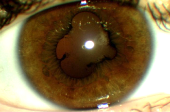 Meilensteine in Diagnostik und Therapie bei Entzündung des Augeninneren