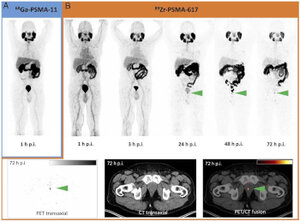 Prostata-spezifisches Membran-Antigen (PSMA) PET/CT Untersuchung eines 66-jährigen Mannes